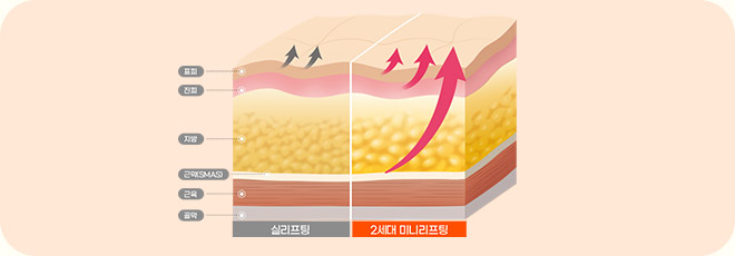 파워 미니리프팅 이미지 1