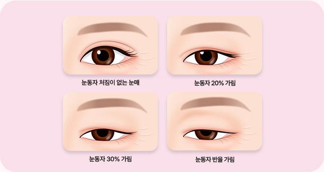 눈매 처짐 진단 이미지