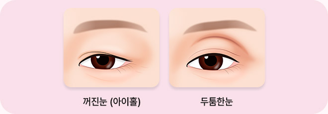 눈꺼풀의 볼륨 이미지
