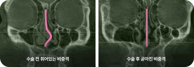 수술 전 휘어있는 비중격. 수술 후 곧아진 비중격