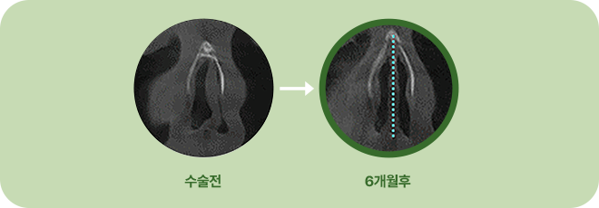 수술전. 6개월 후