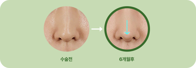 수술전. 6개월 후