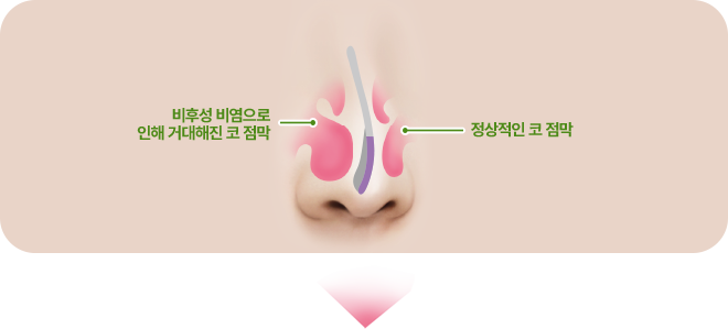비후성 비염으로 인해 거대해진 코 점막. 정상적인 코 점막