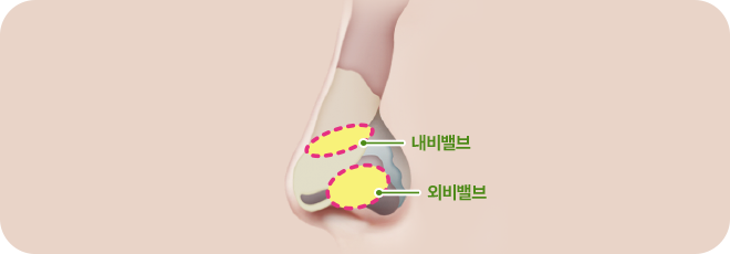 내비밸브, 외비밸브