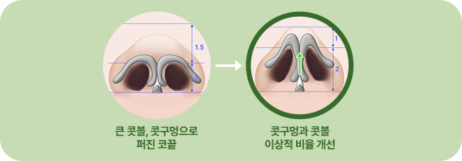 큰 콧볼 콧구멍으로 퍼진 코끝. 콧구멍과 콧볼 이상적 비율개선