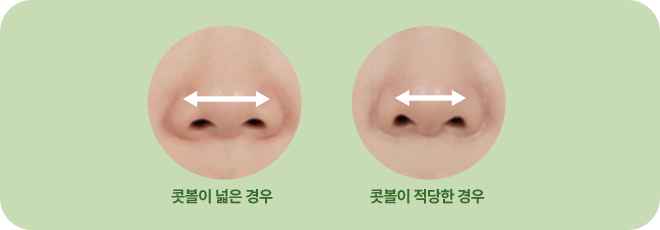 콧볼이 넓은 경우. 콧볼이 적당한 경우.