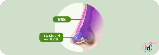 보형물. 조각디자인된 자가늑연골