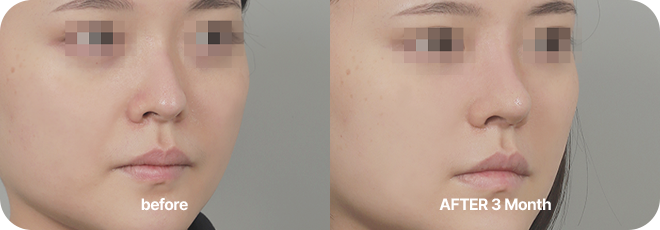 before. after 3 month