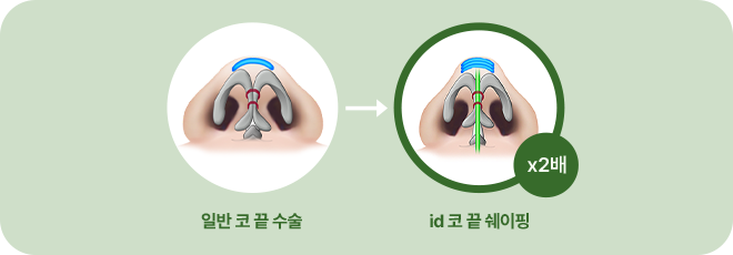 일반 코 끝 수술. id 코 끝 쉐이핑(x2배)