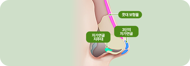 콧대 보형물. 자가연골 지주대. 3단의 자가연골