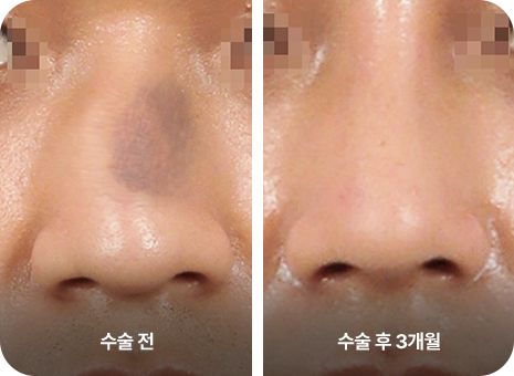 수술전. 수술 후 3개월