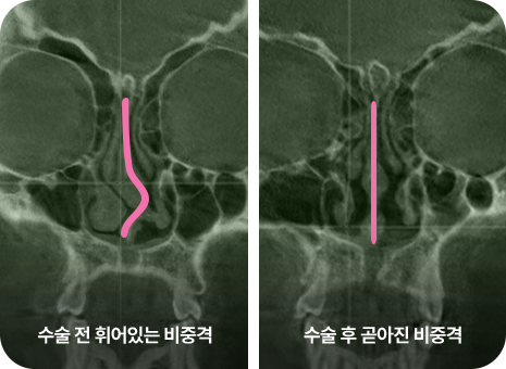 수술 전 휘어있는 비중격. 수술 후 곧아진 비중격