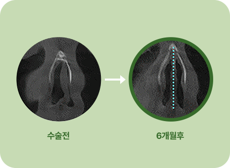수술전. 6개월 후