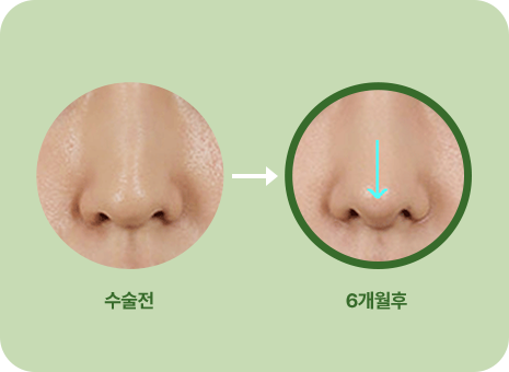 수술전. 6개월 후
