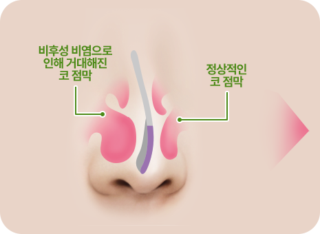비후성 비염으로 인해 거대해진 코 점막. 정상적인 코 점막