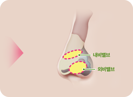 내비밸브, 외비밸브