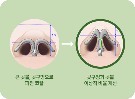큰 콧볼 콧구멍으로 퍼진 코끝. 콧구멍과 콧볼 이상적 비율개선