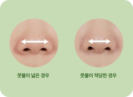 콧볼이 넓은 경우. 콧볼이 적당한 경우.