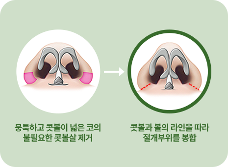 뭉툭하고 콧볼이 넓은 코의 불필요한 콧볼살 제거. 콧볼과 볼의 라인을 따라 절개부위를 봉합.