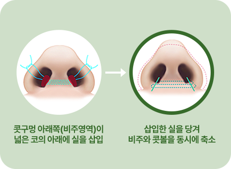 콧구멍 아래쪽(비주영역)이 넓은 코의 아래에 실을 삽입. 삽입한 실을 당겨 비주와 콧볼을 동시에 축소.