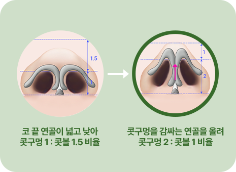 코 끝 연골이 넓고 낮아 콧구명1: 콧볼 1.5비율. 콧구명을 감싸는 연골을 올려 콧구명2:콧볼1비율