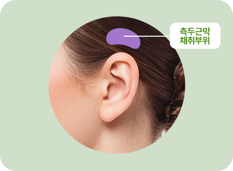 측두근막 채취부위
