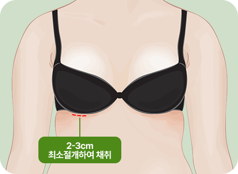 2~3cm 최소절개하여 채취