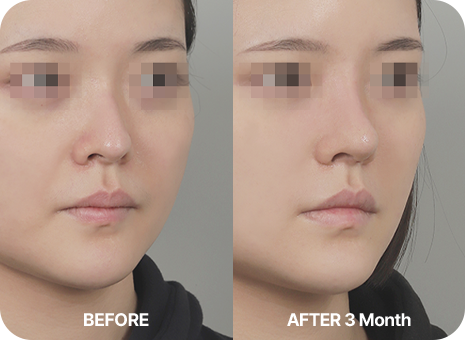 before. after 3 month