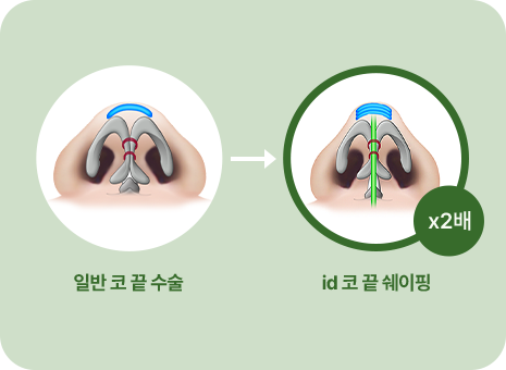 일반 코 끝 수술. id 코 끝 쉐이핑(x2배)
