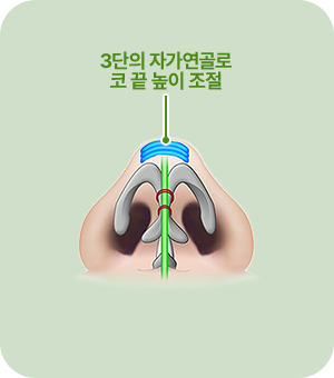 3단의 자가연골로 코 끝 높이 조절